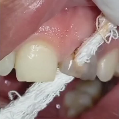 TEETH RESTORATION